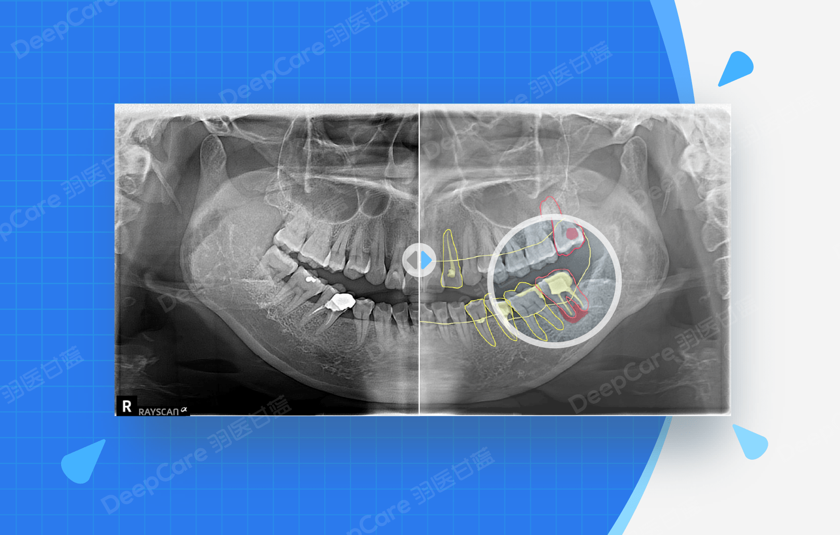 中国、「AI歯科医」を開発　治療水準の向上へ