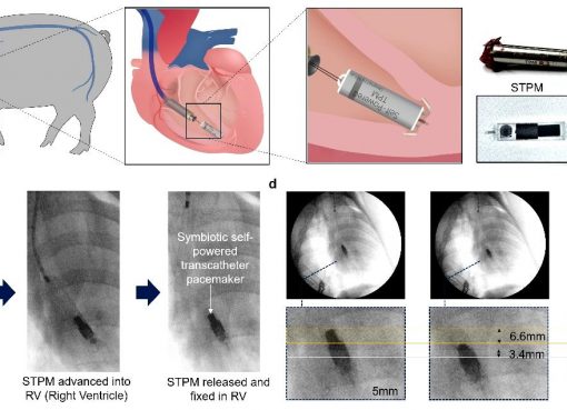 「一生、電池切れしない」心臓デバイス　拍動発電ペースメーカーを中国で開発成功
